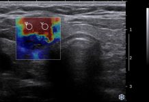 Stijfheid van de pees geeft meer zekerheid over diagnose fasciitis plantaris