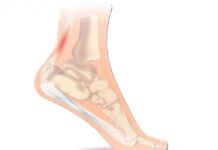 Wandelblessure 2: ‘Achillespeesontsteking’