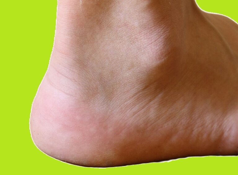 Wandelblessure 1: Peroneus tendinopathie