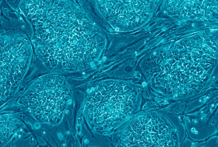 Stamceltherapie kan helpen bij diabetische voetulcera