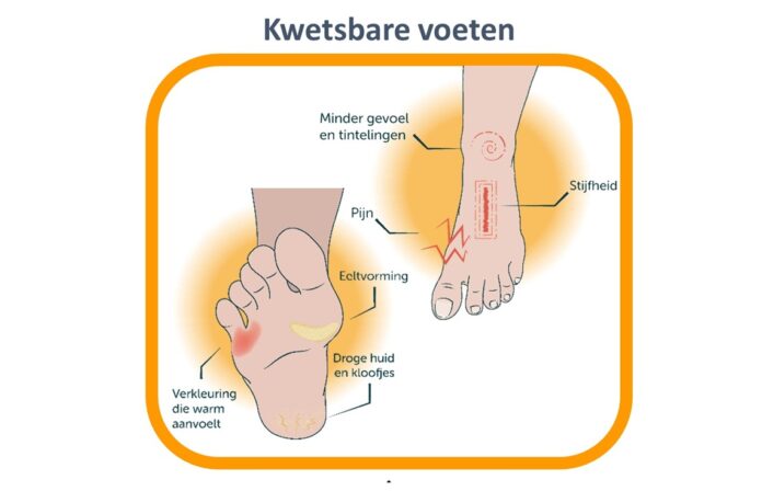 voorlichting kwetsbare voeten