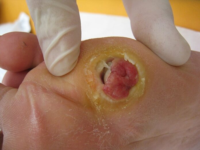 diabetische voetulcus