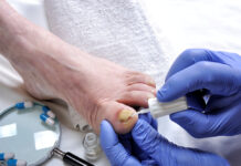 Schimmelnagel? Eerst de diagnose, dan pas behandelen Dermatologist doctor treats a nail affected by onychomycosis following the action of pathogenic fungi.