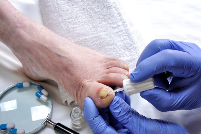 Onychomycosis, nail disease due to the action of pathogenic fungi. Dermatologist doctor treats a nail affected by onychomycosis following the action of pathogenic fungi.