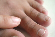 Man toe with skin cracked rough and thick, skin problems on toe.