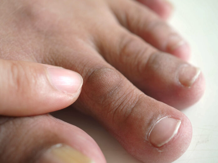Man toe with skin cracked rough and thick, skin problems on toe. closeup photo, blurred. Man toe with skin cracked rough and thick, skin problems on toe.
