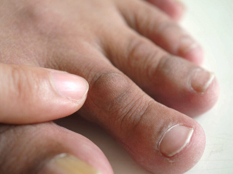 Nagelverandering kan meer zijn dan een cosmetisch probleem Man toe with skin cracked rough and thick, skin problems on toe.