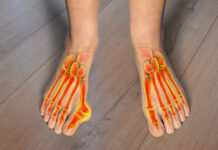 Meer beweeglijkheid in de voet bij een hallux valgus? Toe deformation, also known as hallux valgus, or bunion
