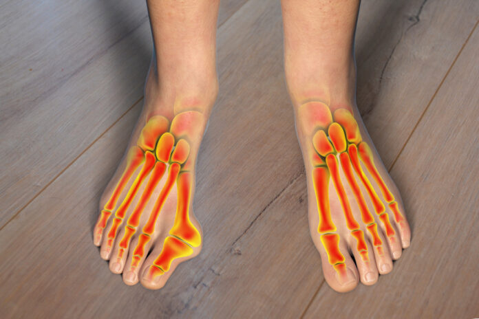 Toe deformation, also known as hallux valgus, or bunion Toe deformation, also known as hallux valgus, or bunion