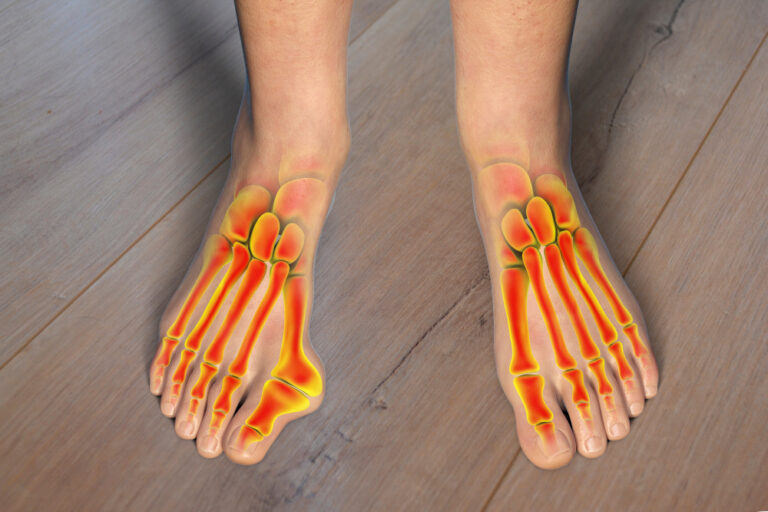 Meer beweeglijkheid in de voet bij een hallux valgus? Toe deformation, also known as hallux valgus, or bunion