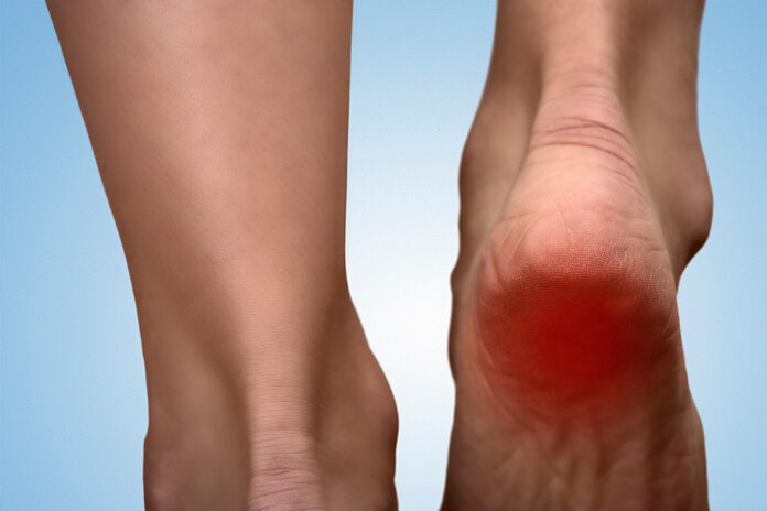 Painful heel with red spot on woman's foot Painful heel with red spot on woman's foot. Arthritis. Sole spur concept. Heel pain in women.