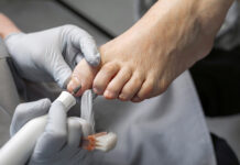 Frezen en reinigen van afwijkende teennagels kan klachten verminderen The process of filing off a thickened old nail from the fingers of an elderly woman. Procedure podologist.