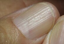Lichen planus in finger nails