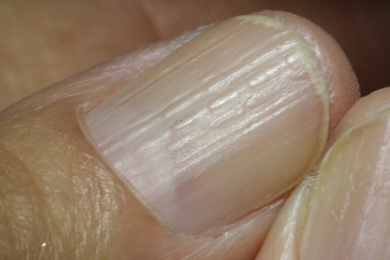 Diabetes kan leiden tot gestreepte nagels Lichen planus in finger nails